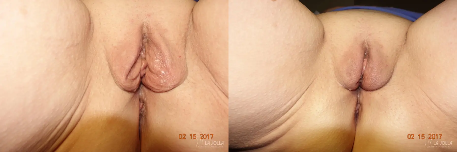 ThermiVa®: Patient 6 - Before and After  