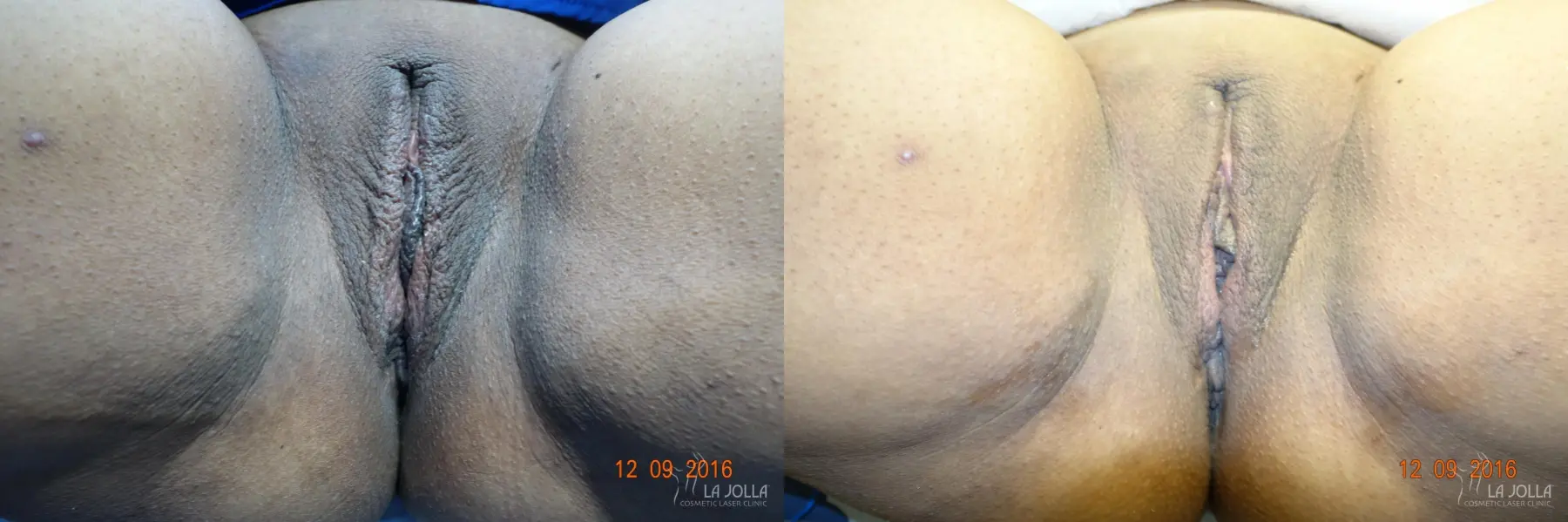 ThermiVa®: Patient 5 - Before and After  