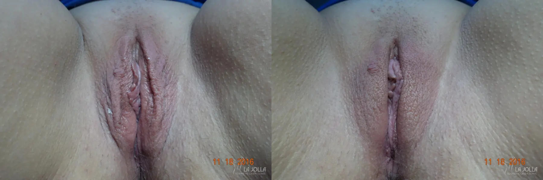 ThermiVa®: Patient 3 - Before and After  