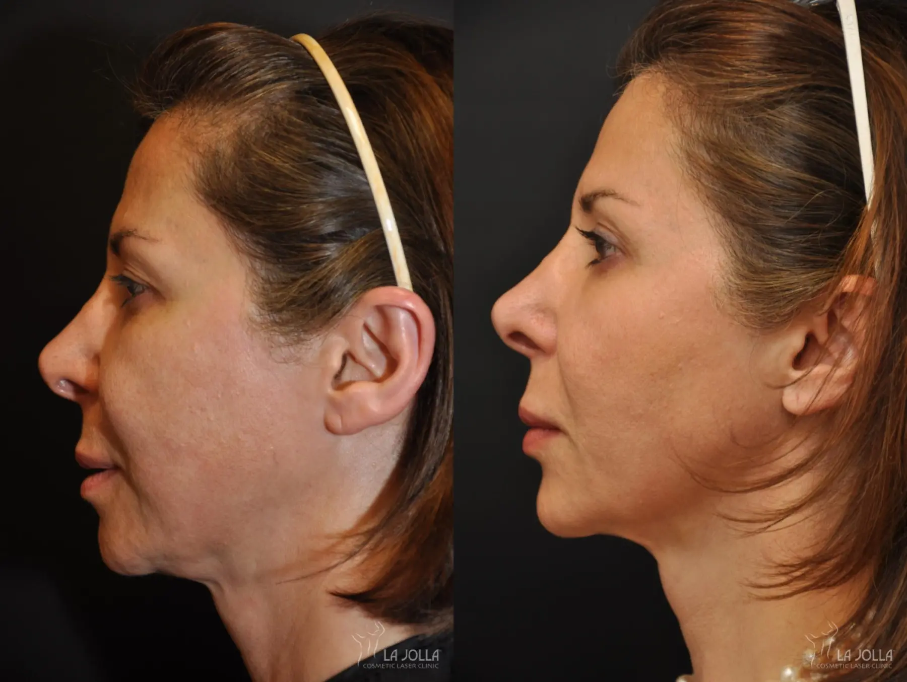 Ultherapy®: Patient 4 - Before and After 1
