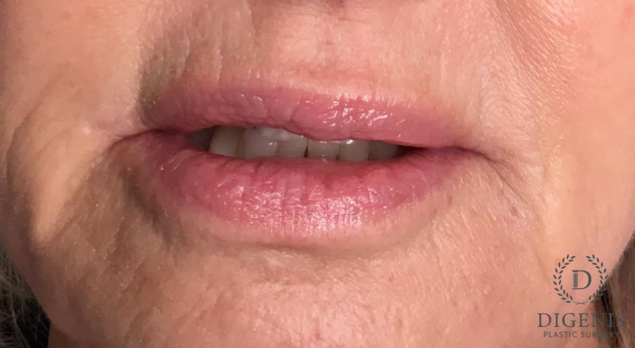 Lip Augmentation: Patient 1 - After  