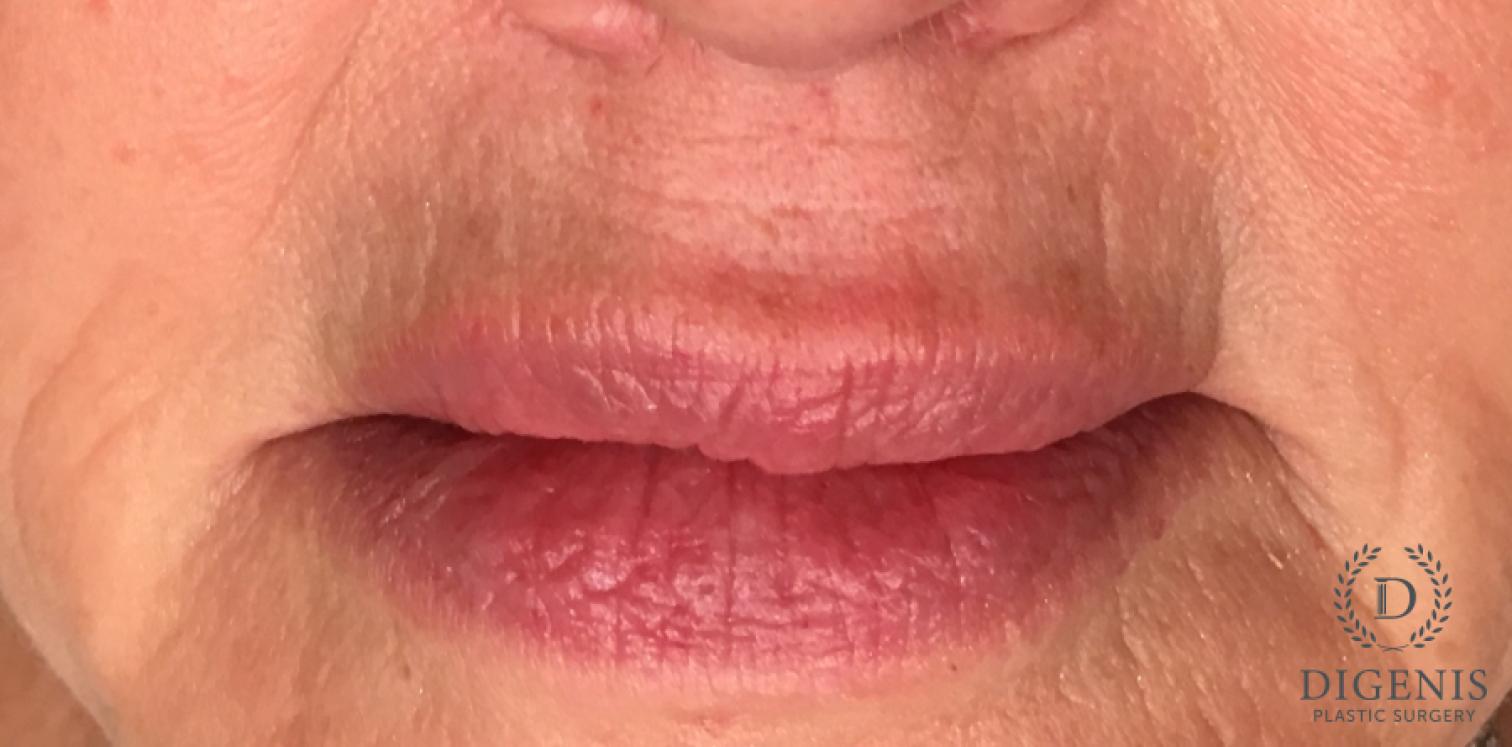 Lip Augmentation: Patient 1 - After  