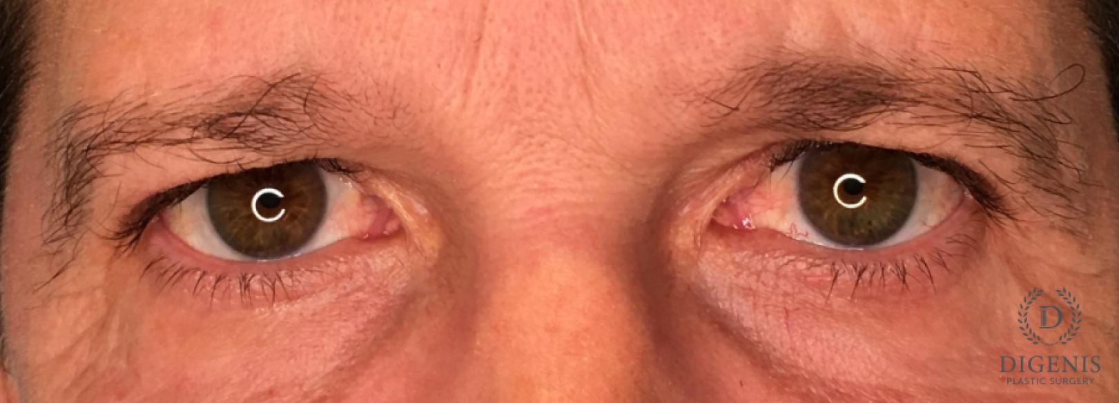 Blepharoplasty: Patient 1 - After  