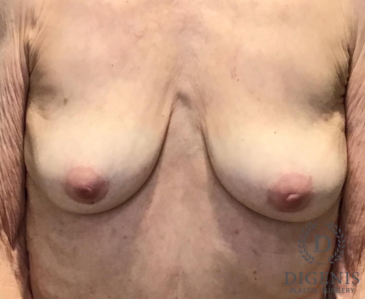 Breast Implant Removal: Patient 1 - After  