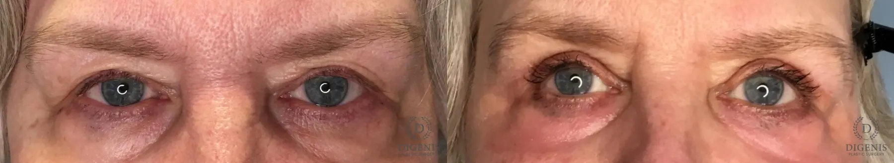 Blepharoplasty: Patient 6 - Before and After  