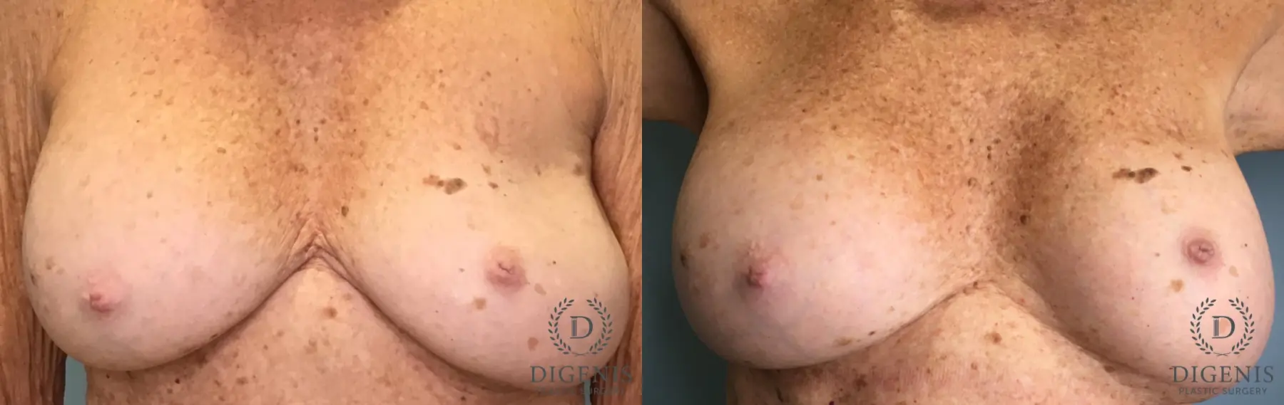 Breast Implant Exchange: Patient 10 - Before and After  