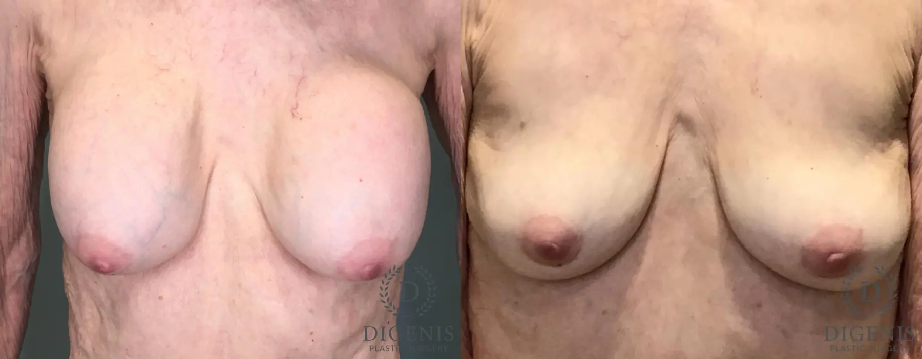 Breast Implant Removal: Patient 1 - Before and After  