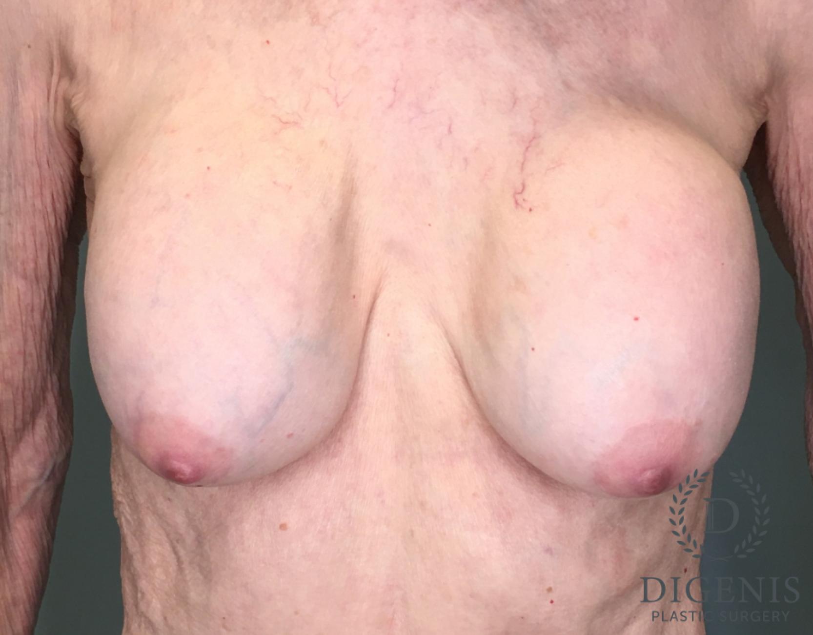 Breast Implant Removal: Patient 1 - After  