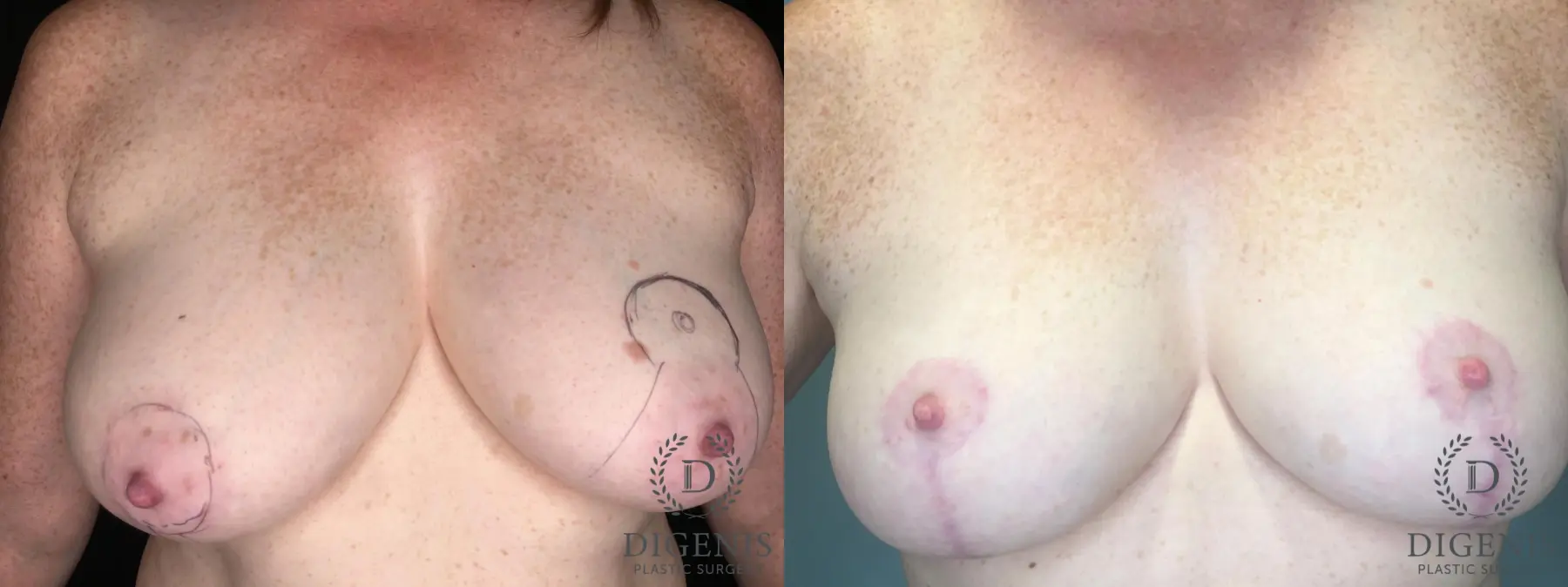 Mastopexy: Patient 6 - Before and After  