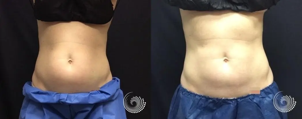 CoolSculpting Elite, reducing fat on her flank and abs, before and