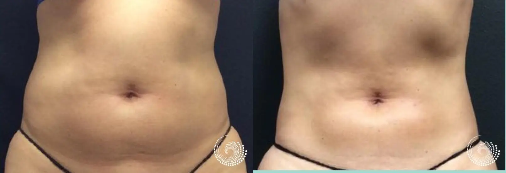 CoolSculpting Elite, reducing fat on tummy & flanks, before and after
