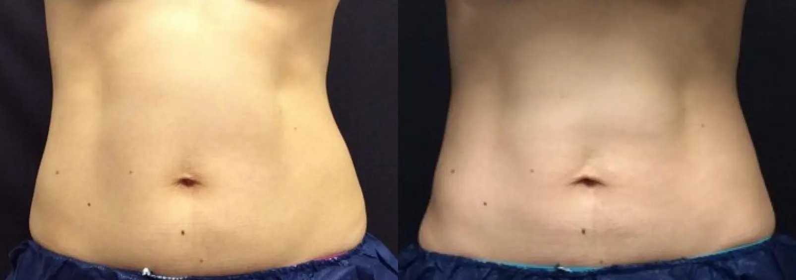 CoolSculpting Elite, reducing fat to sculpt her waist, before and after