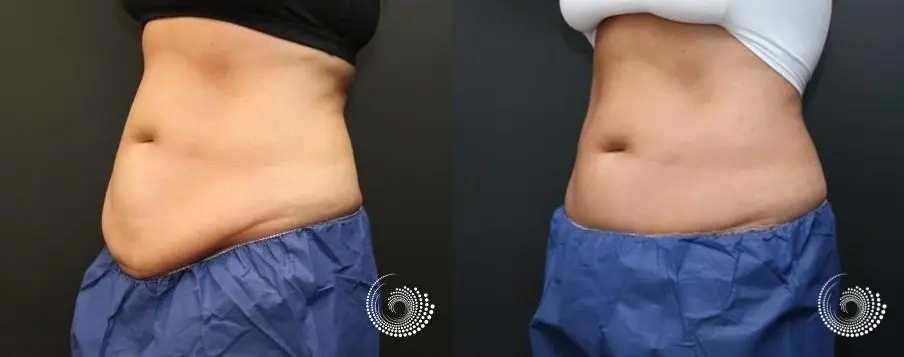 CoolSculpting Before and After Photo Gallery