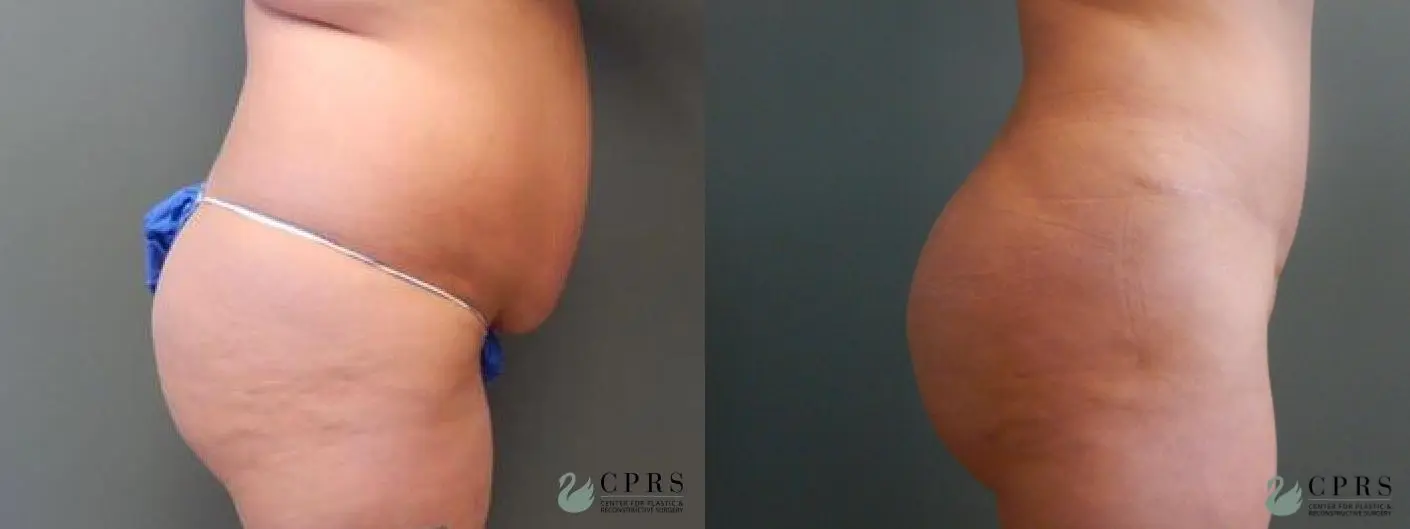 Brazilian Butt Lift Before & After Gallery: Patient 8