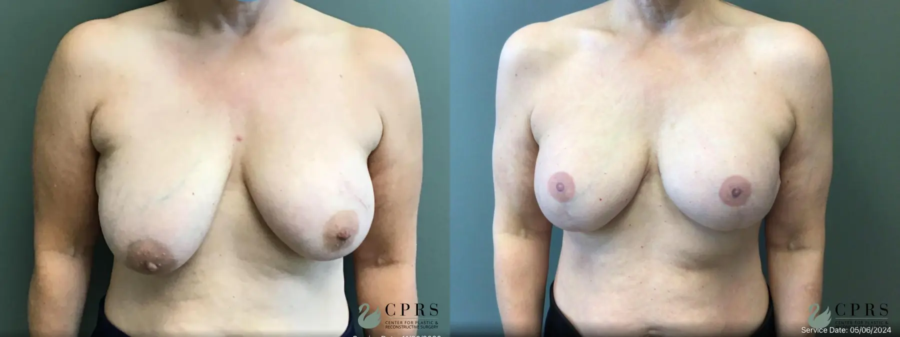 Breast Reconstruction: Patient 10 - Before and After  