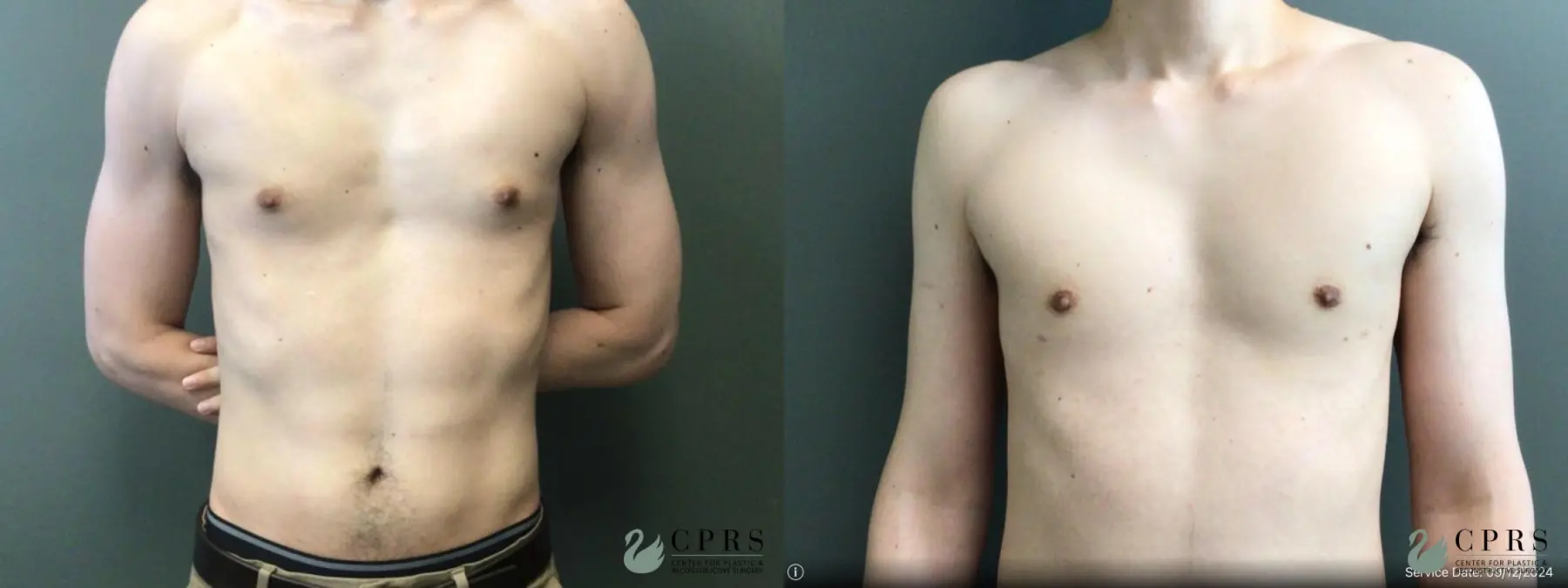 Gynecomastia: Patient 8 - Before and After  