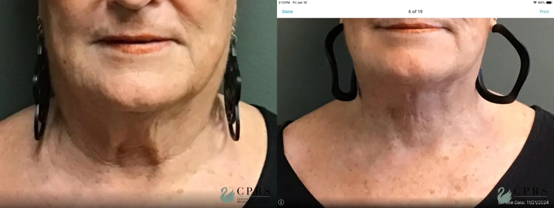 Neck Lift: Patient 1 - Before and After  