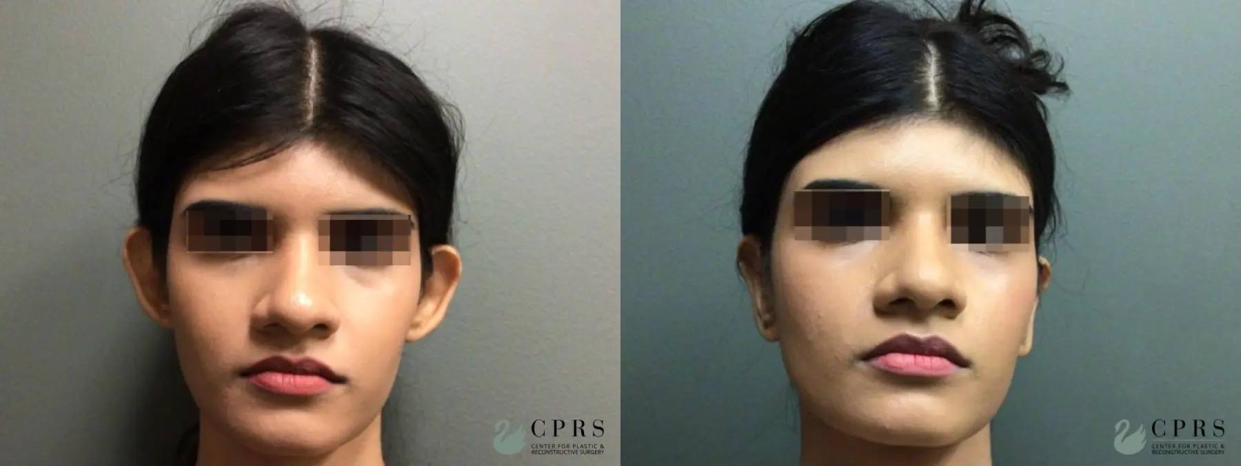 Otoplasty: Patient 3 - Before and After  