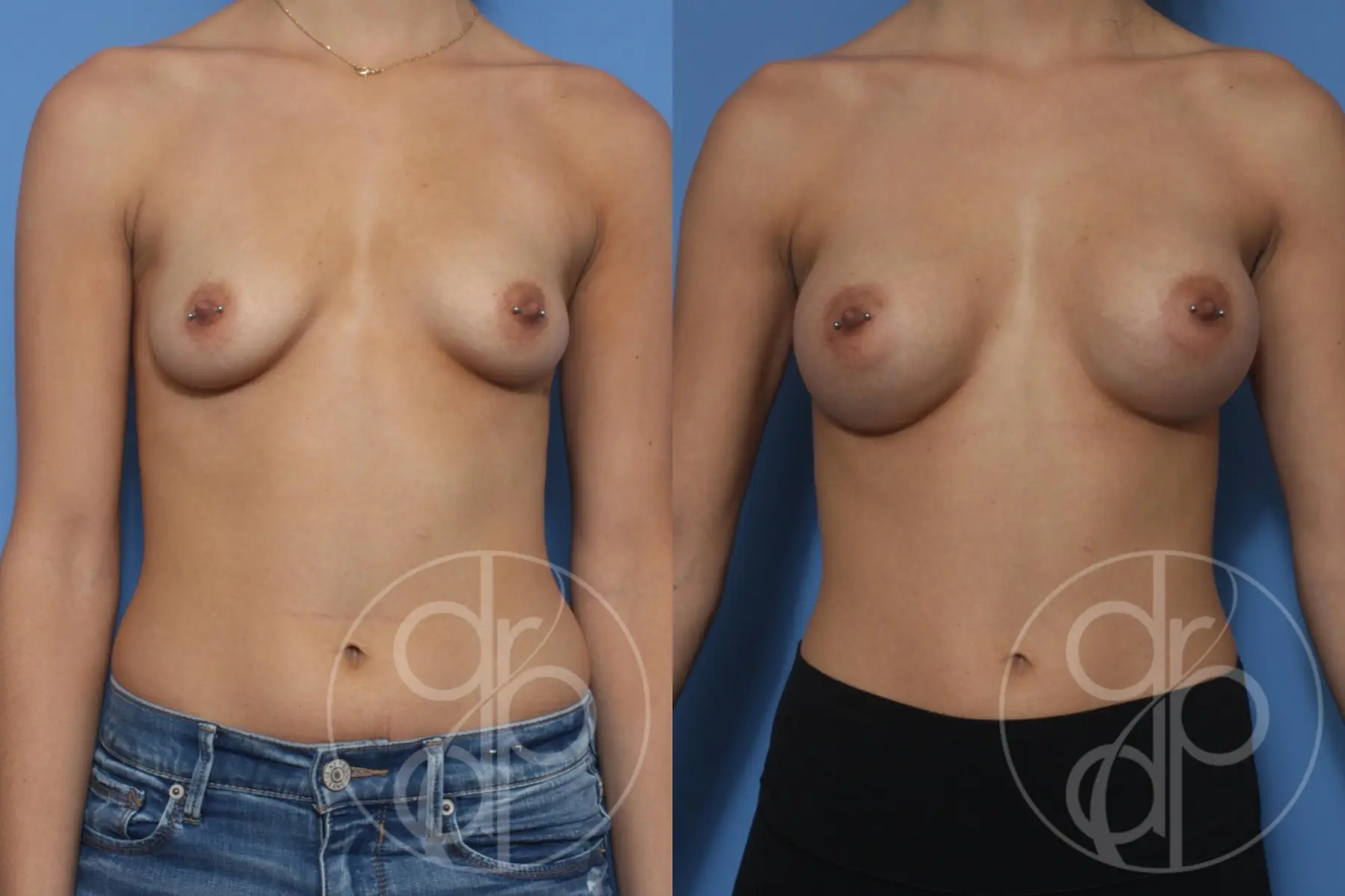 patient 10277 breast augmentation before and after result - Before and After