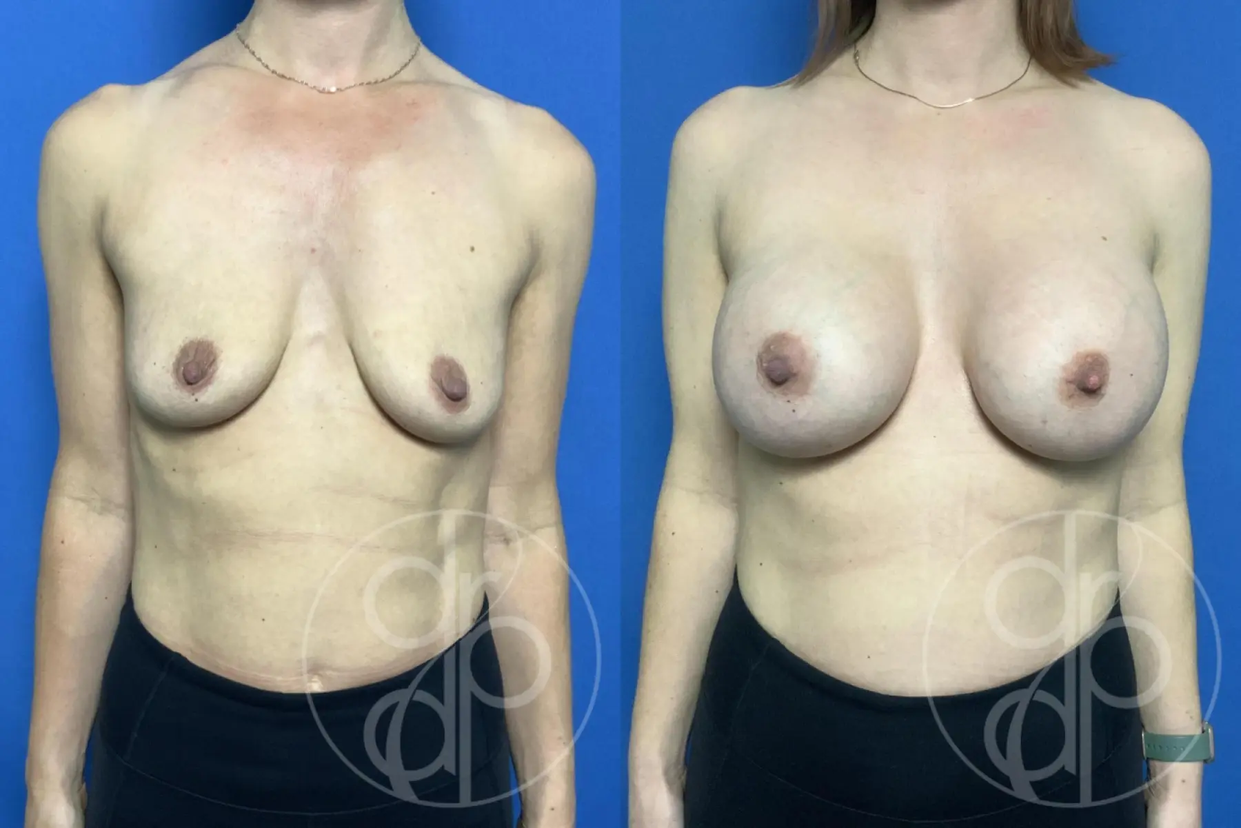 Patient 12096 breast augmentation before and after result - Before and After