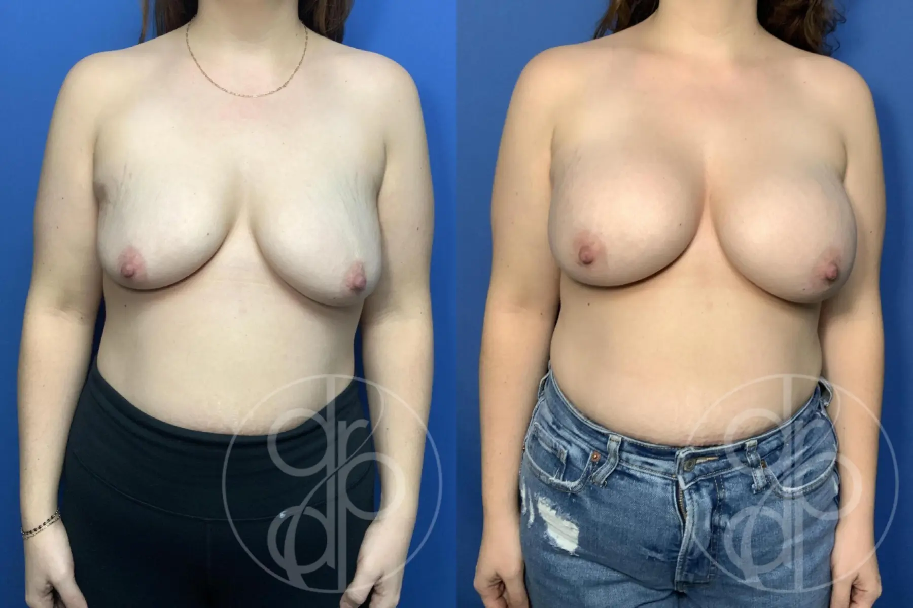 Patient 14366 breast augmentation before and after result - Before and After