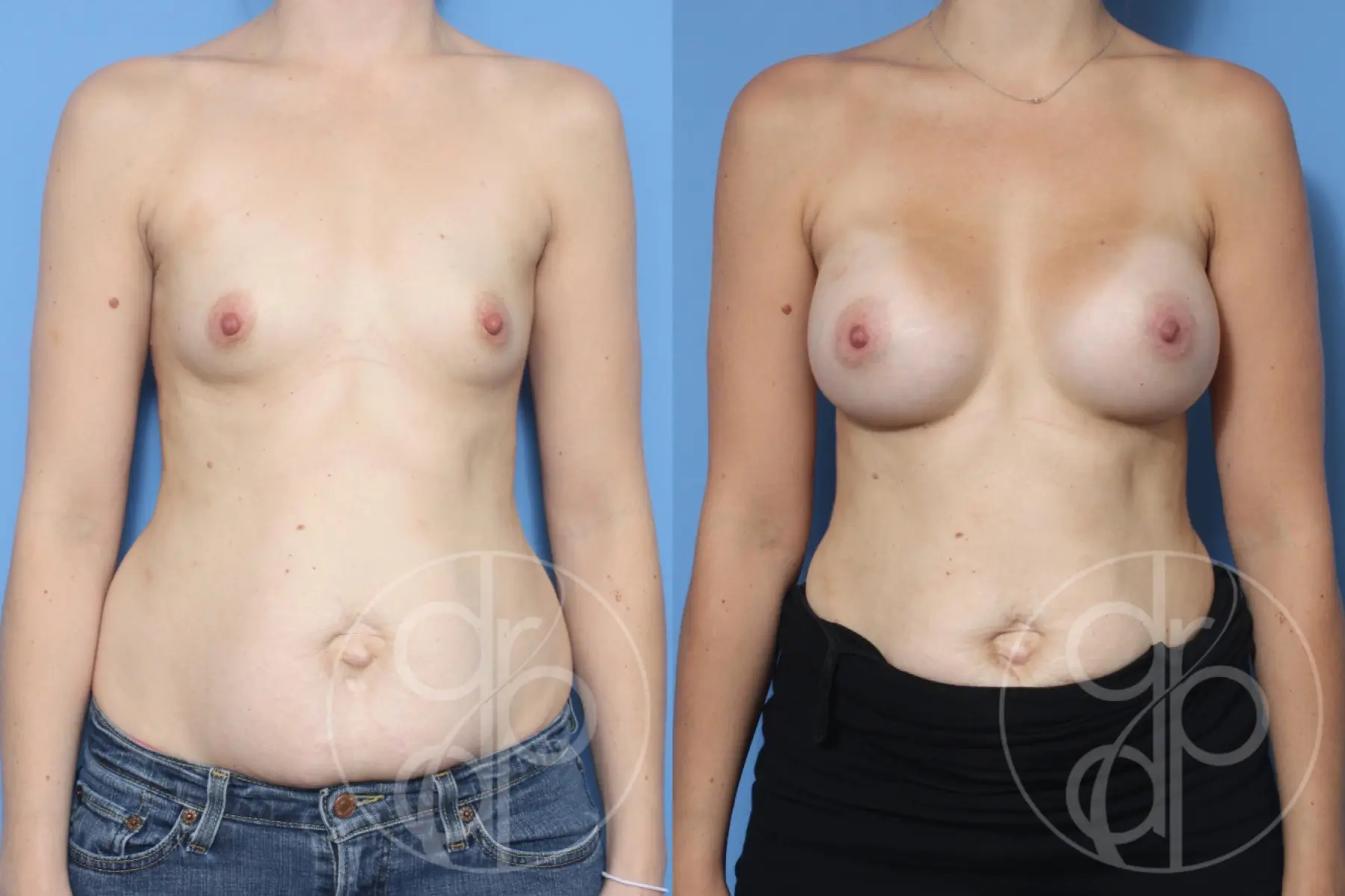 patient 13069 breast augmentation before and after result - Before and After