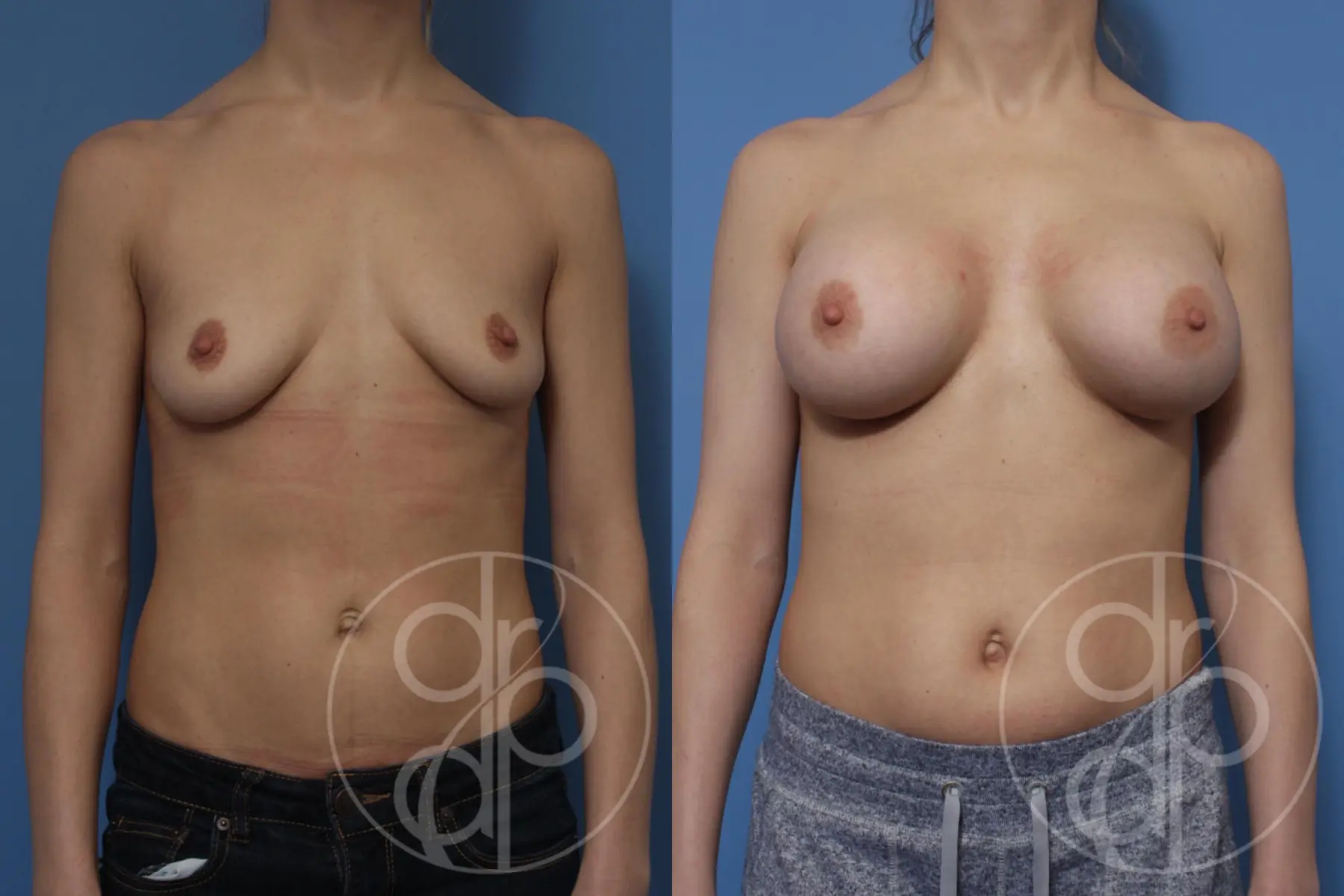 Patient 10395 breast augmentation before and after result - Before and After