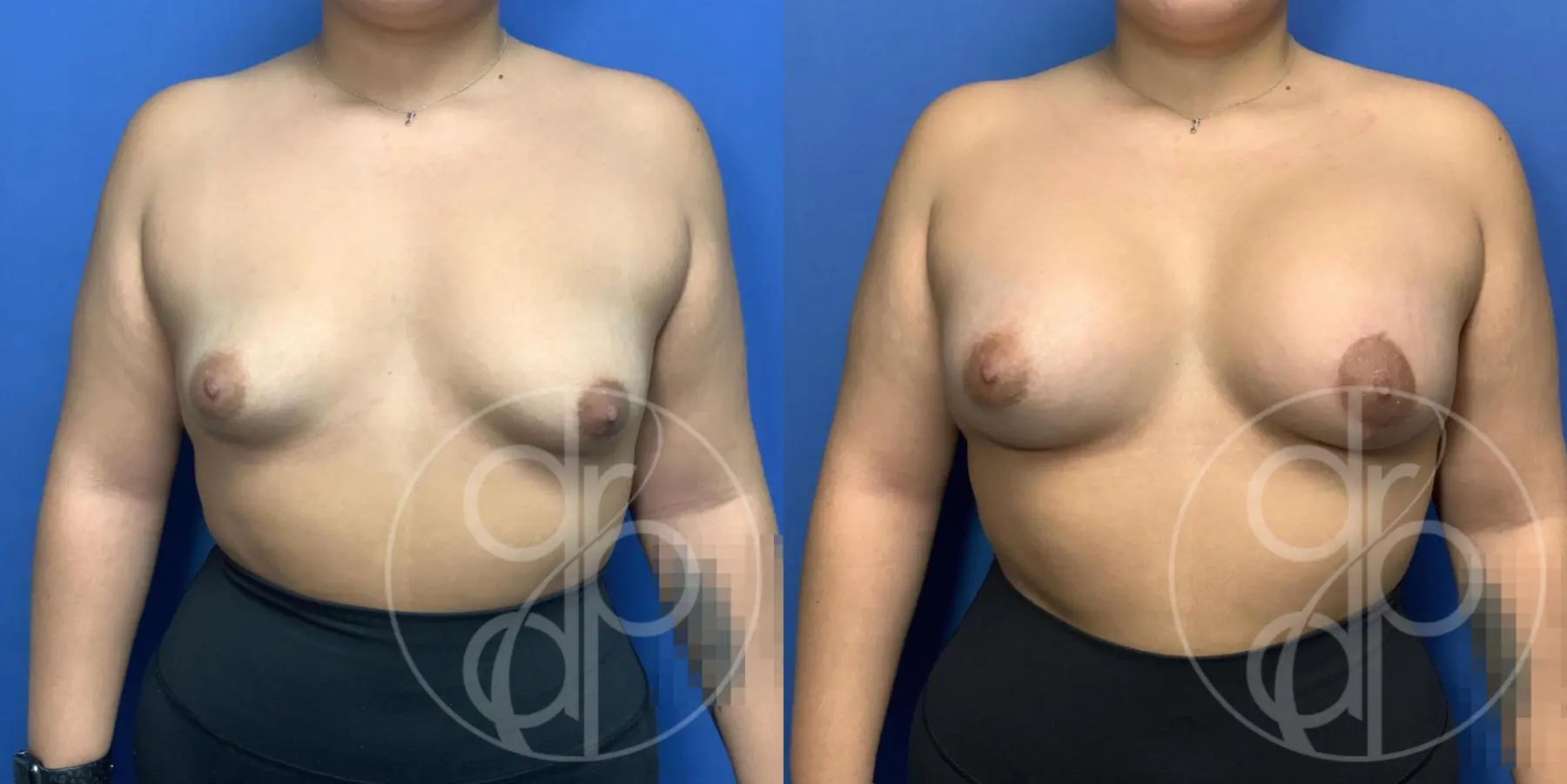 Patient 14126 breast augmentation before and after result - Before and After