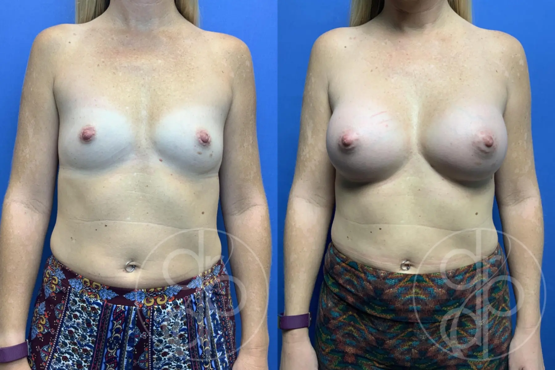 patient 10644 breast augmentation before and after result - Before and After