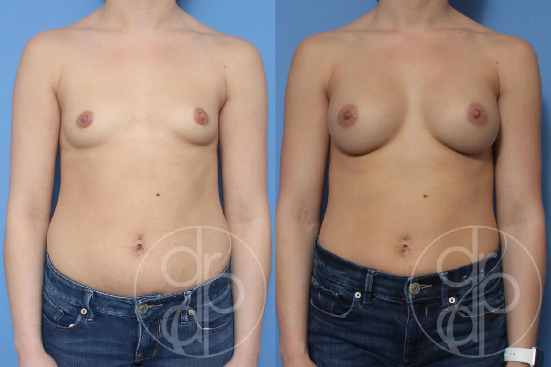 Patient 10444 breast augmentation before and after result - Before and After