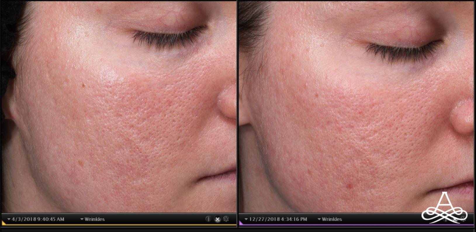  Phoenix AZAcne Scars Before After Gallery