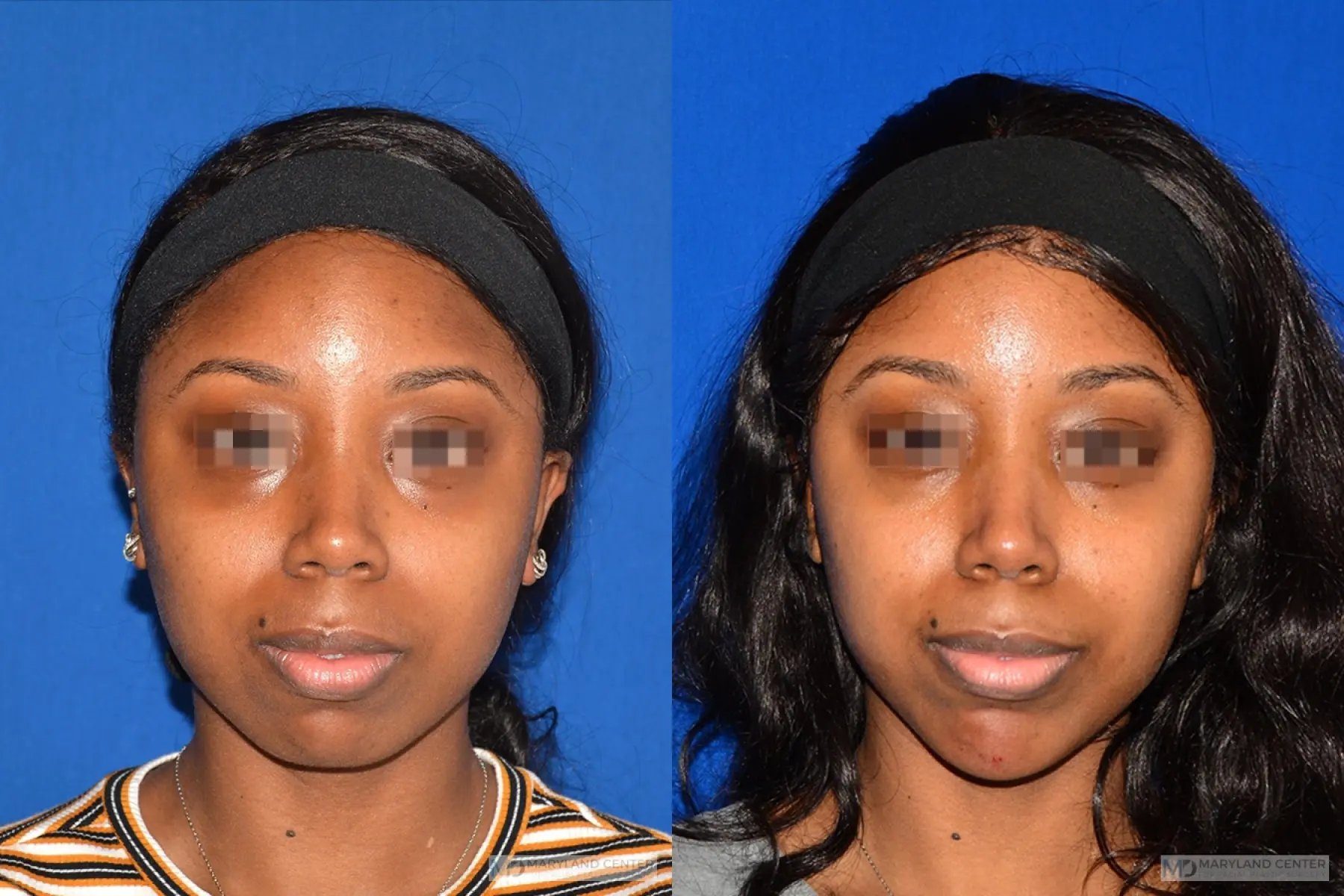 Chin Implant Before And After Kzpzmj716409 Highres.webp