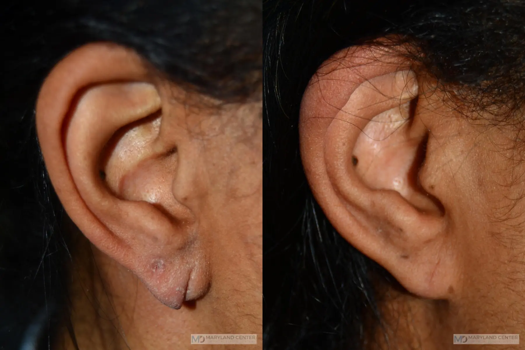 Earlobe Repair: Restore Your Ears with Dr. Lopes - Cosmetic