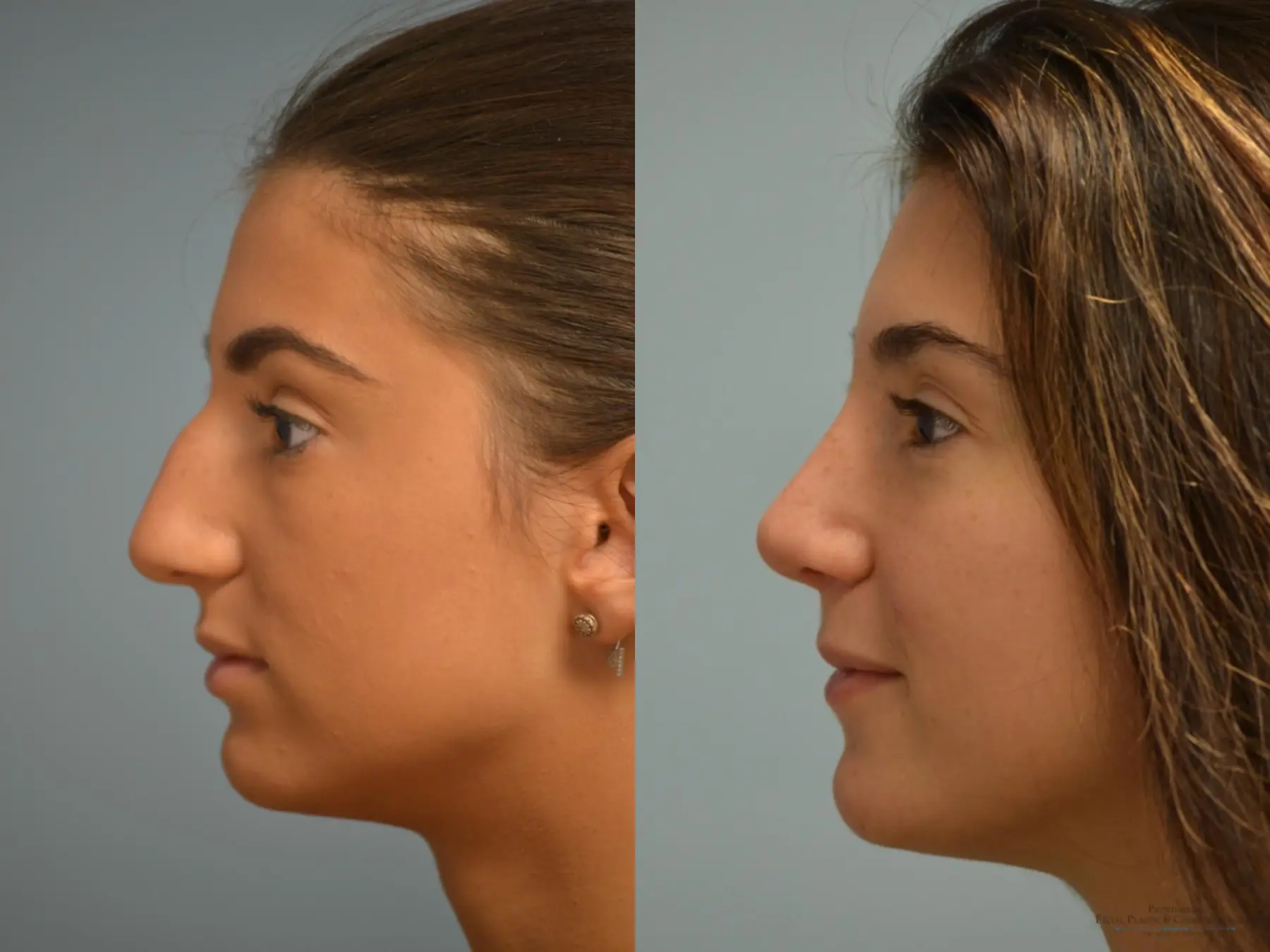 Rhinoplasty: Patient 18 - Before and After 4