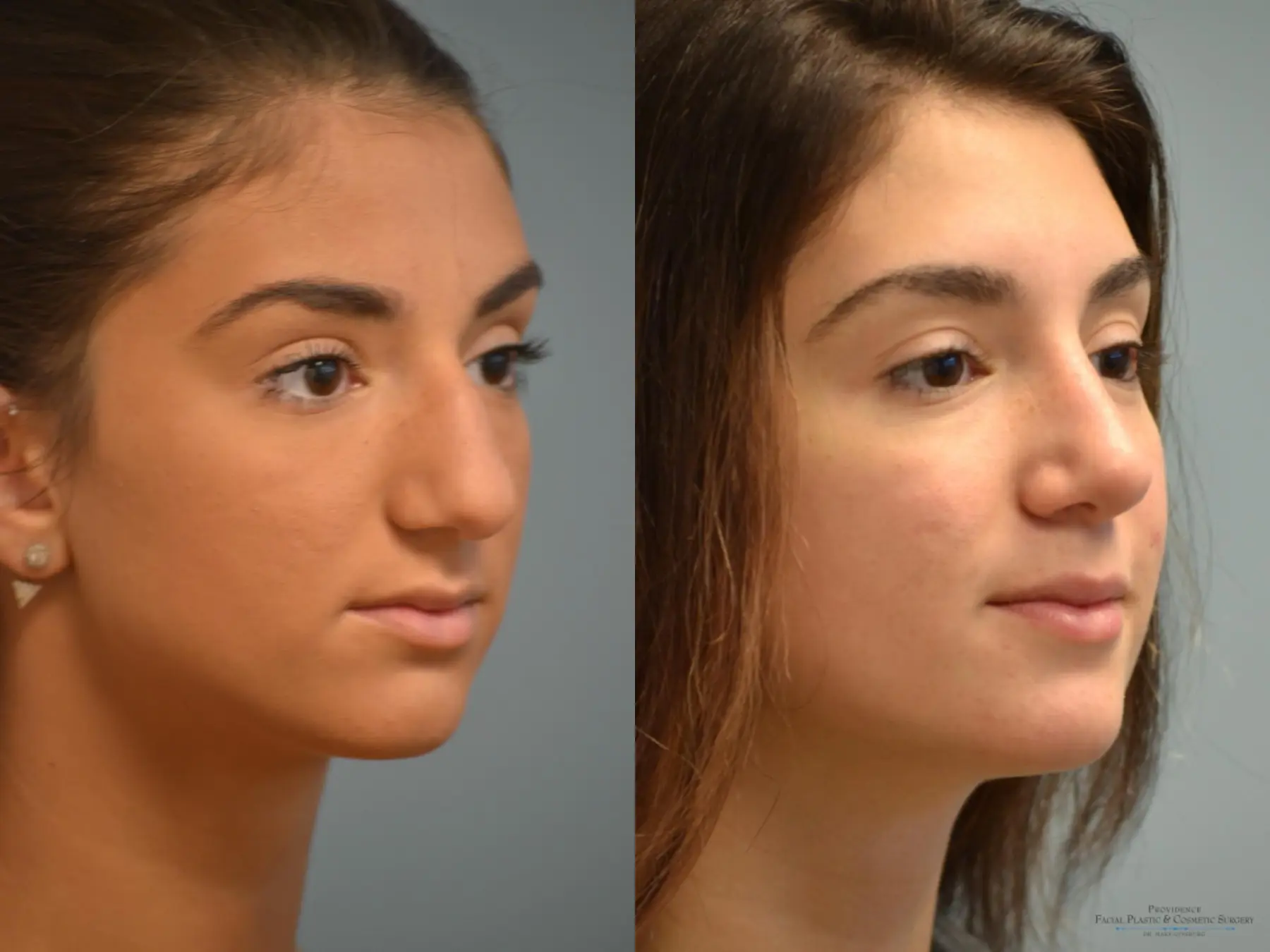 Rhinoplasty: Patient 18 - Before and After 2