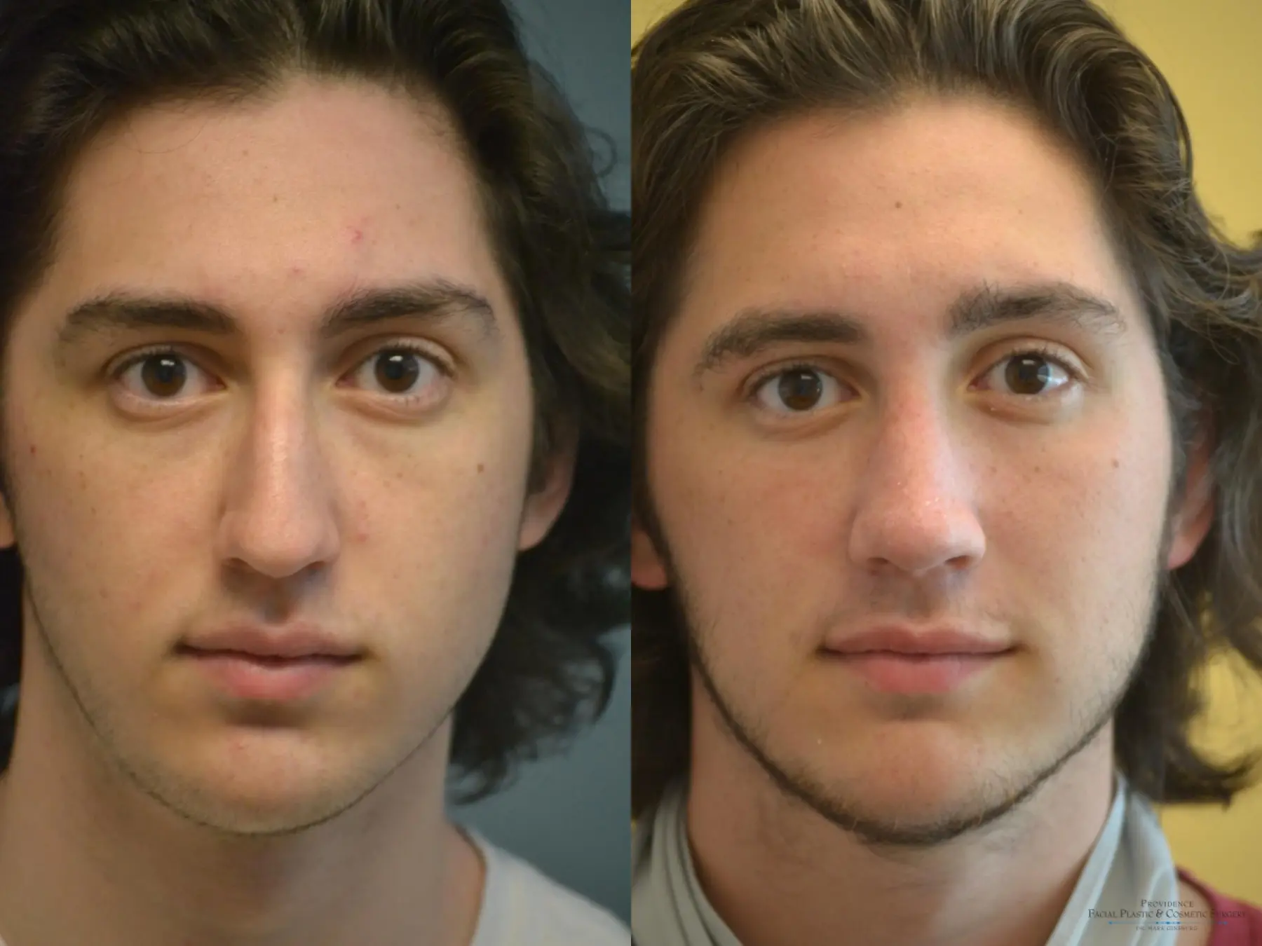 Rhinoplasty: Patient 15 - Before and After 1