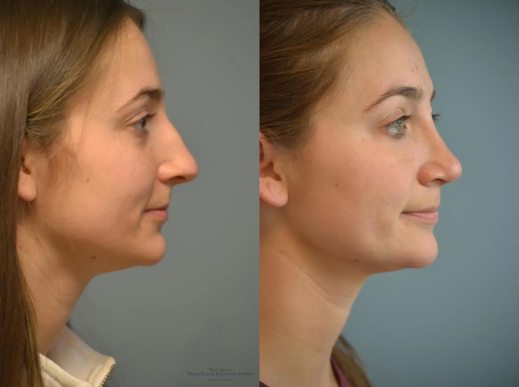 Rhinoplasty: Patient 21 - Before and After 4