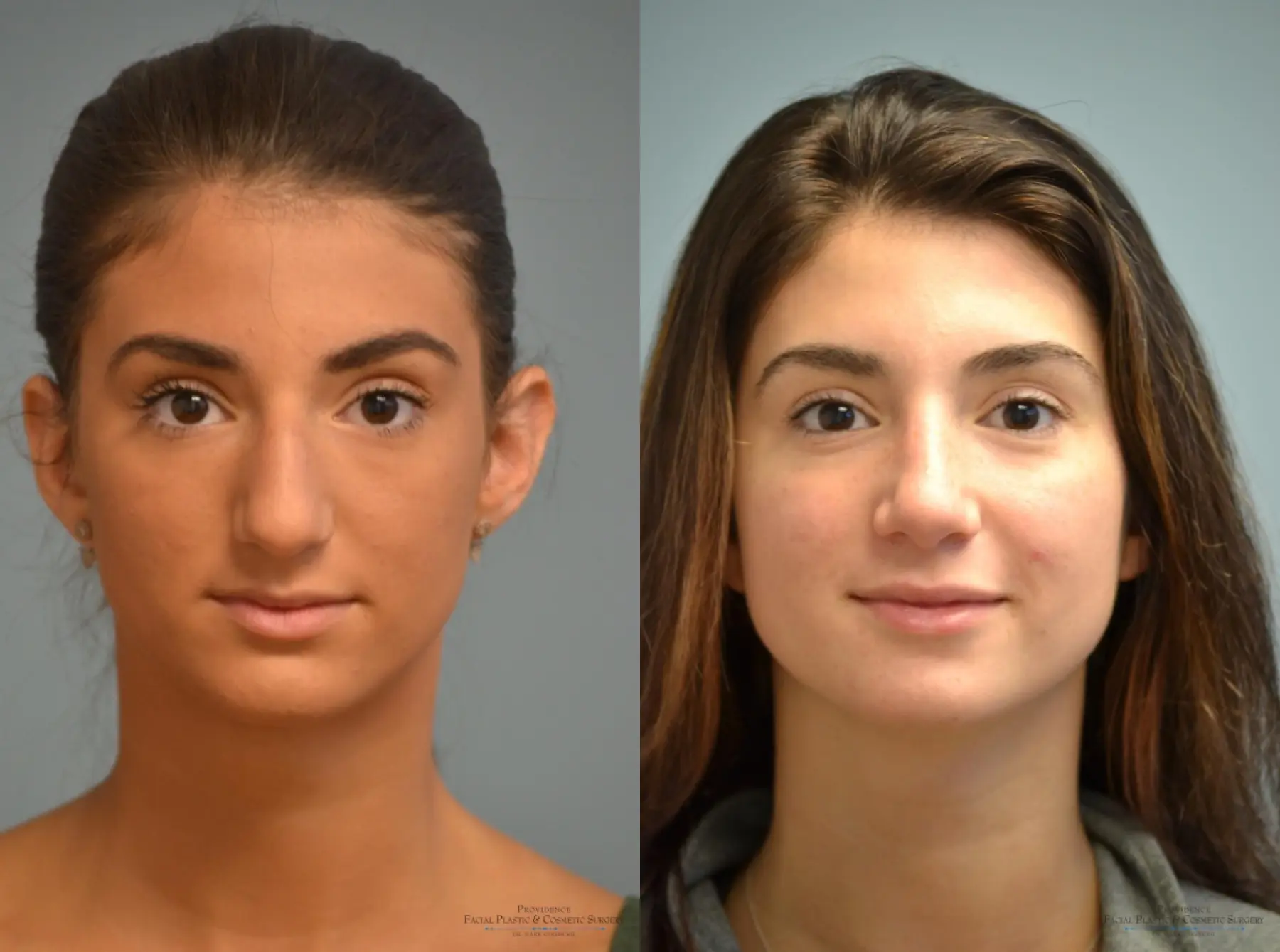 Rhinoplasty: Patient 18 - Before and After 1