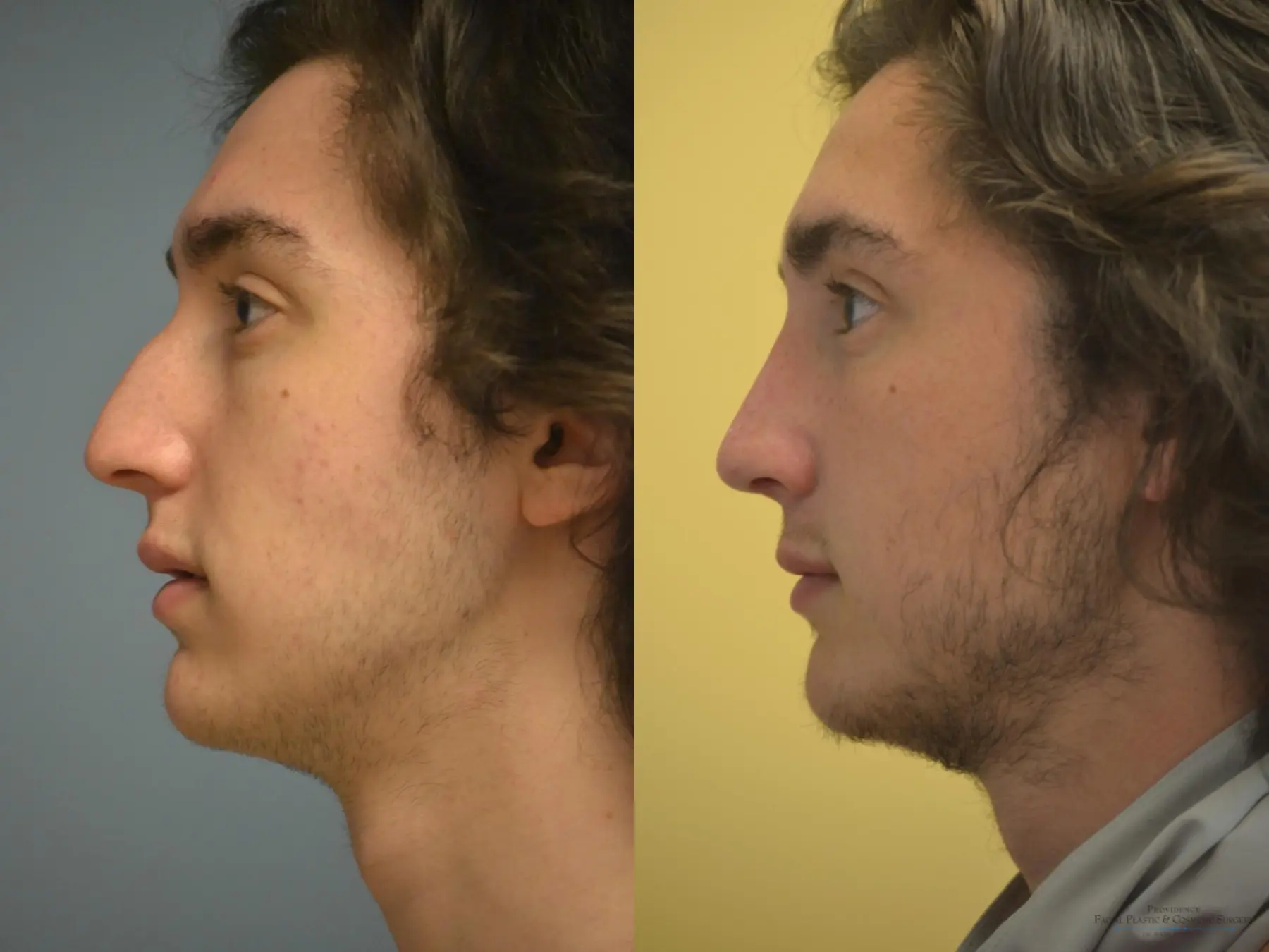 Rhinoplasty: Patient 15 - Before and After 3