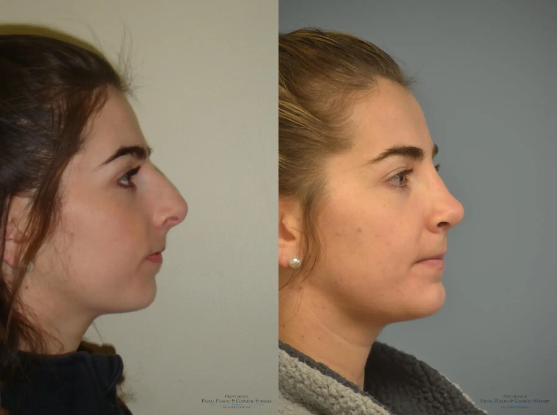 Rhinoplasty: Patient 23 - Before and After 2