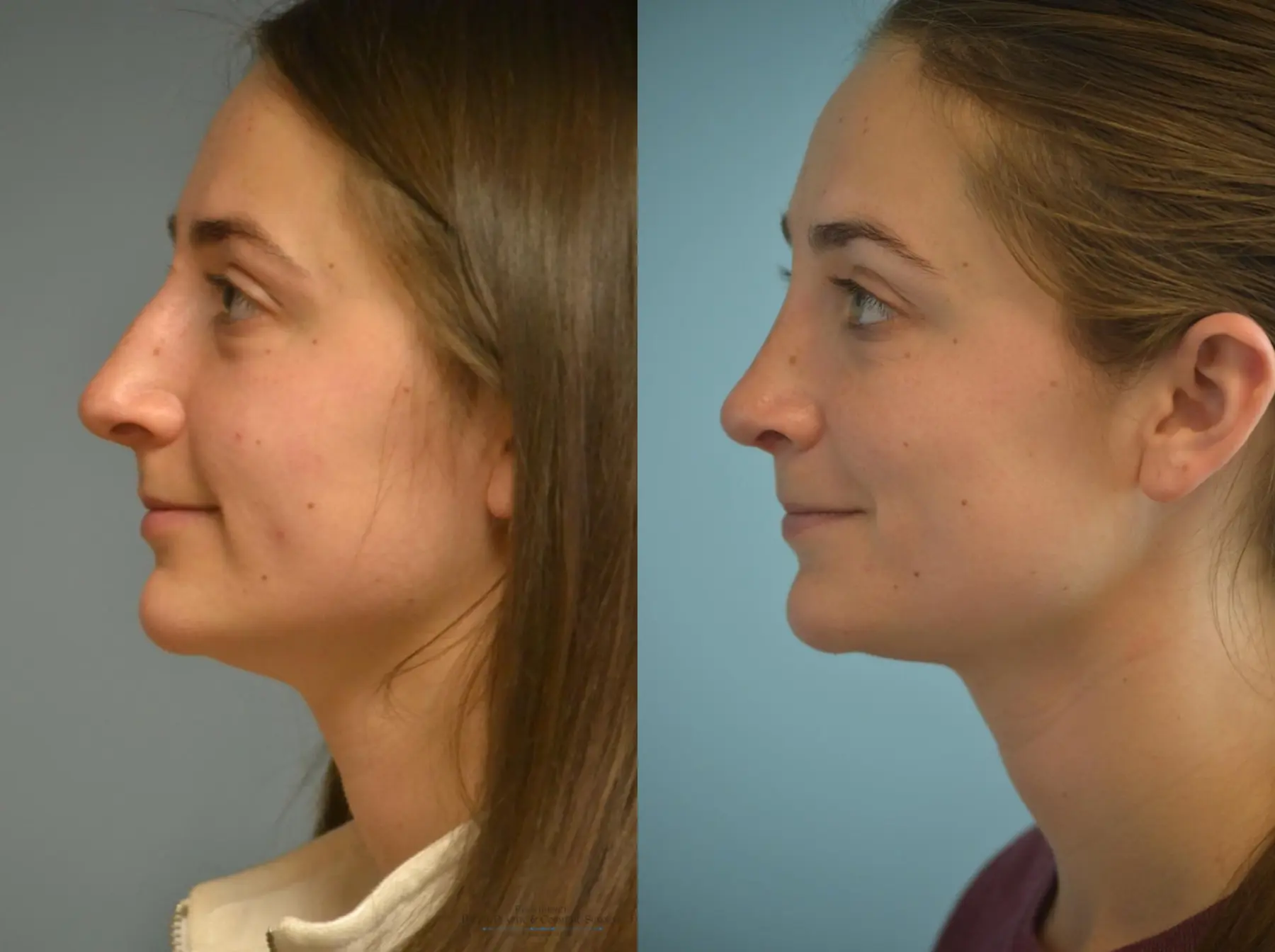 Rhinoplasty: Patient 21 - Before and After 3