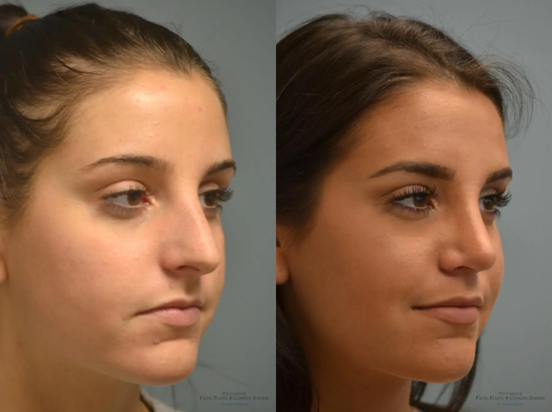 Rhinoplasty: Patient 17 - Before and After 4