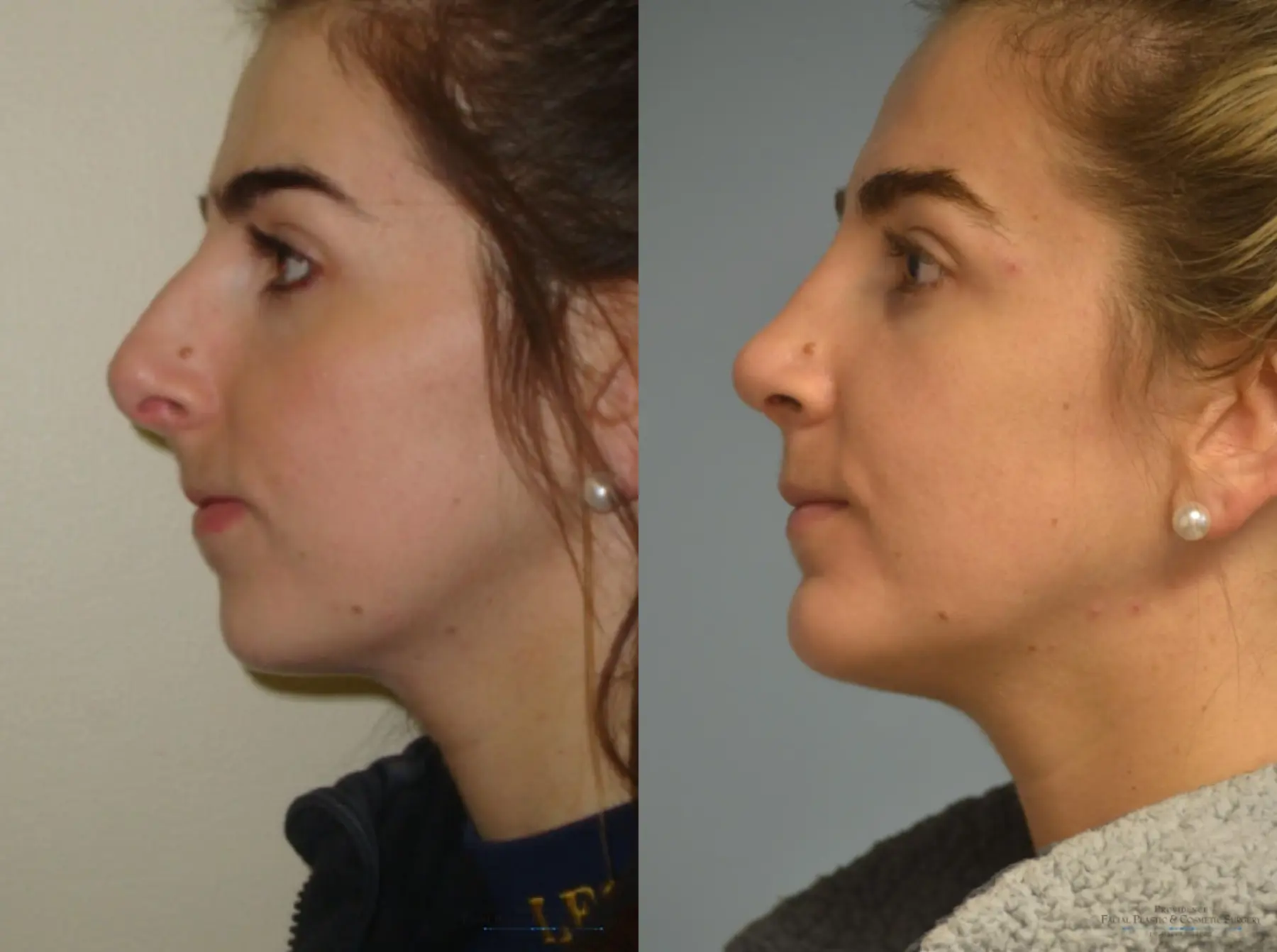 Rhinoplasty: Patient 23 - Before and After 4