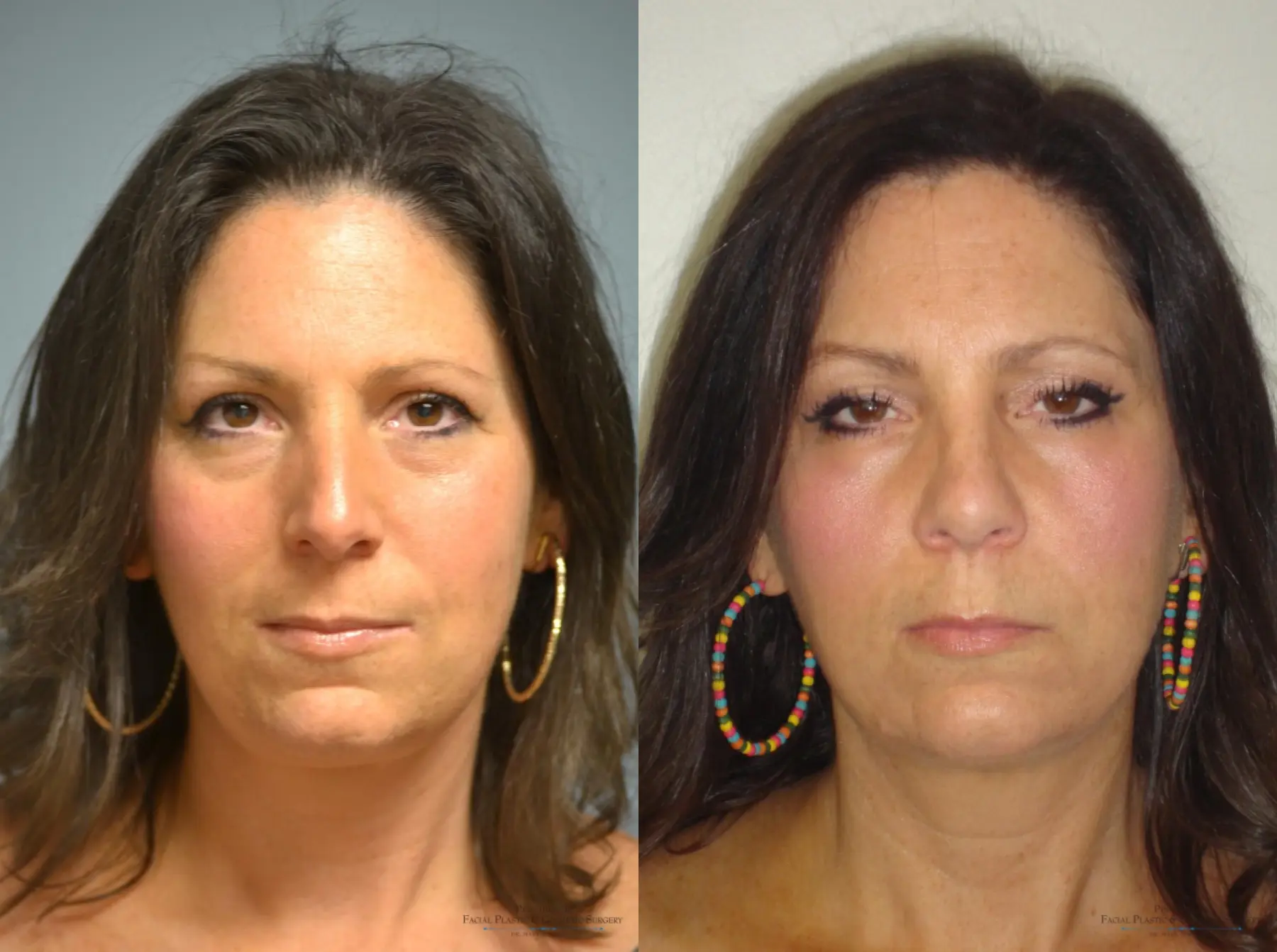 Rhinoplasty: Patient 16 - Before and After 1