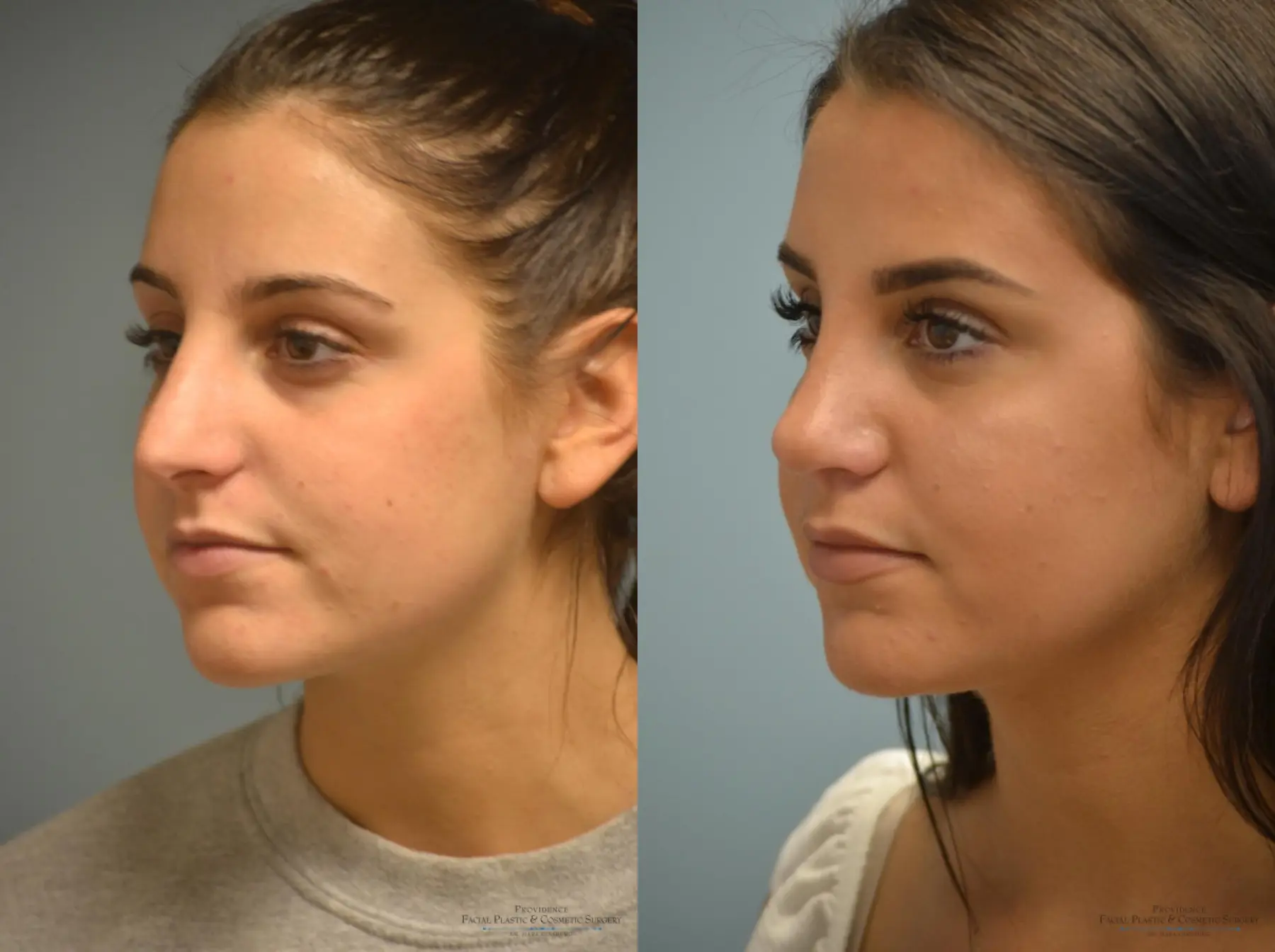 Rhinoplasty: Patient 17 - Before and After 2