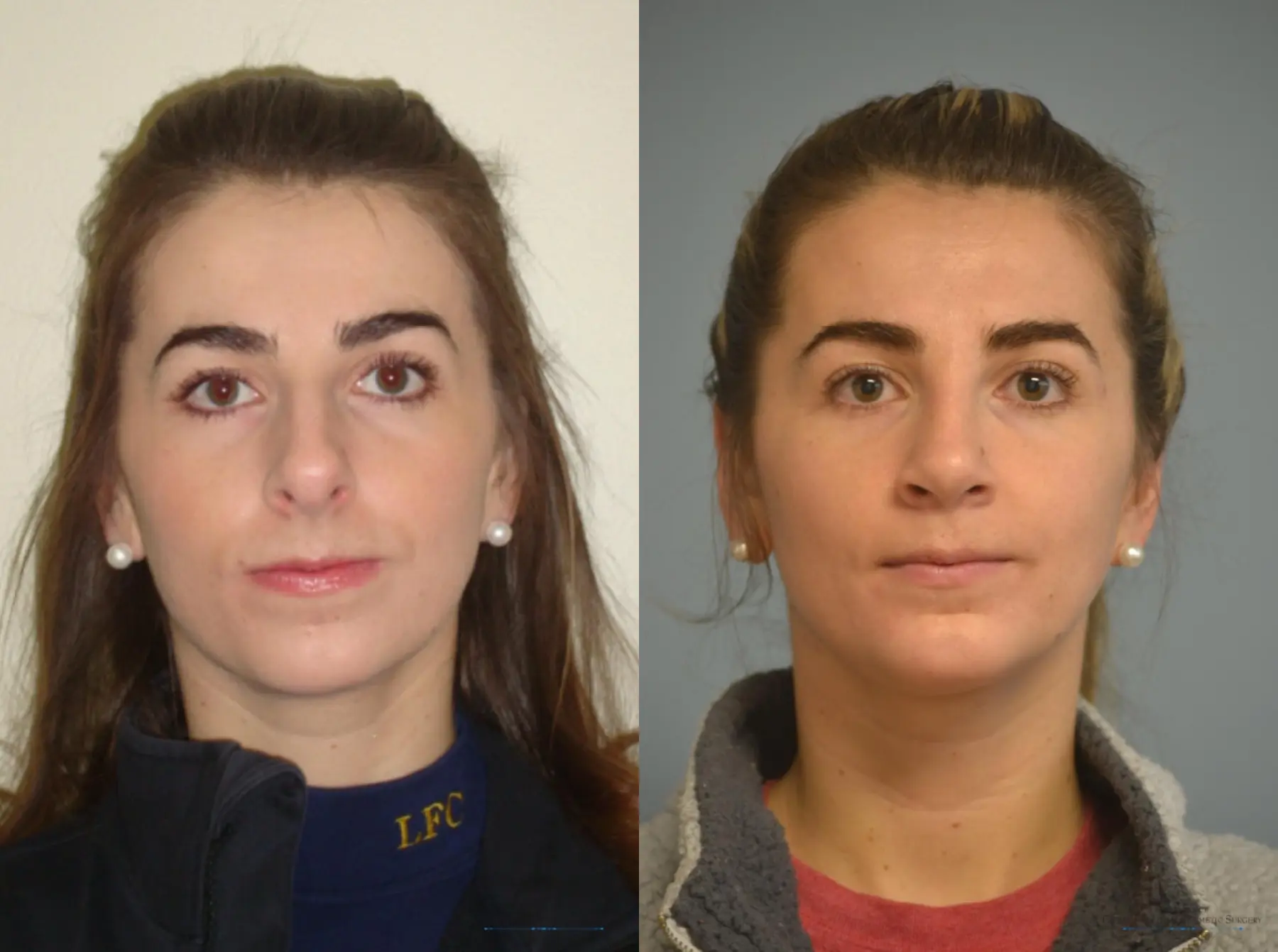 Rhinoplasty: Patient 23 - Before and After 1