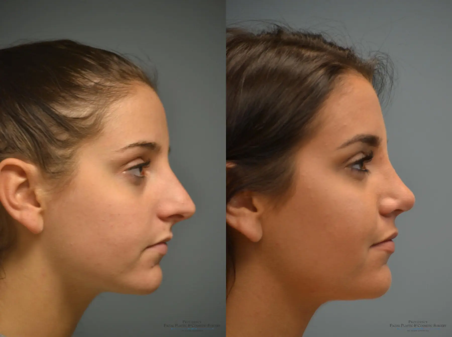 Rhinoplasty: Patient 17 - Before and After 5