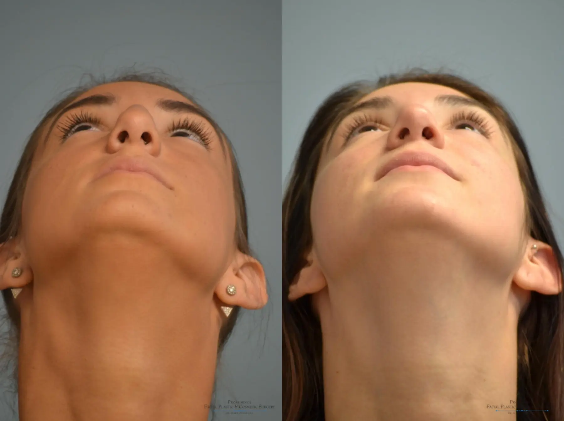 Rhinoplasty: Patient 18 - Before and After 5