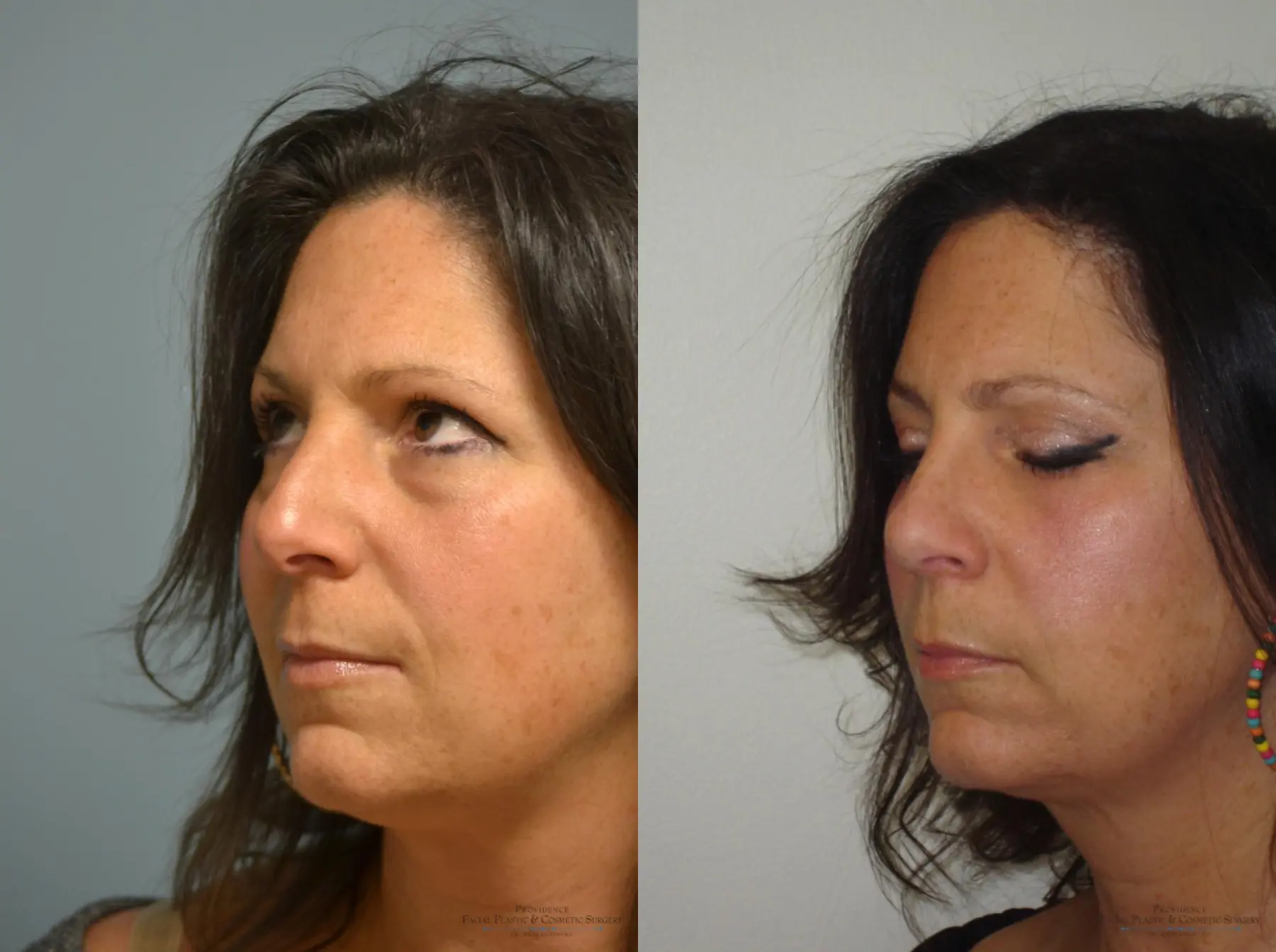 Rhinoplasty: Patient 16 - Before and After 2