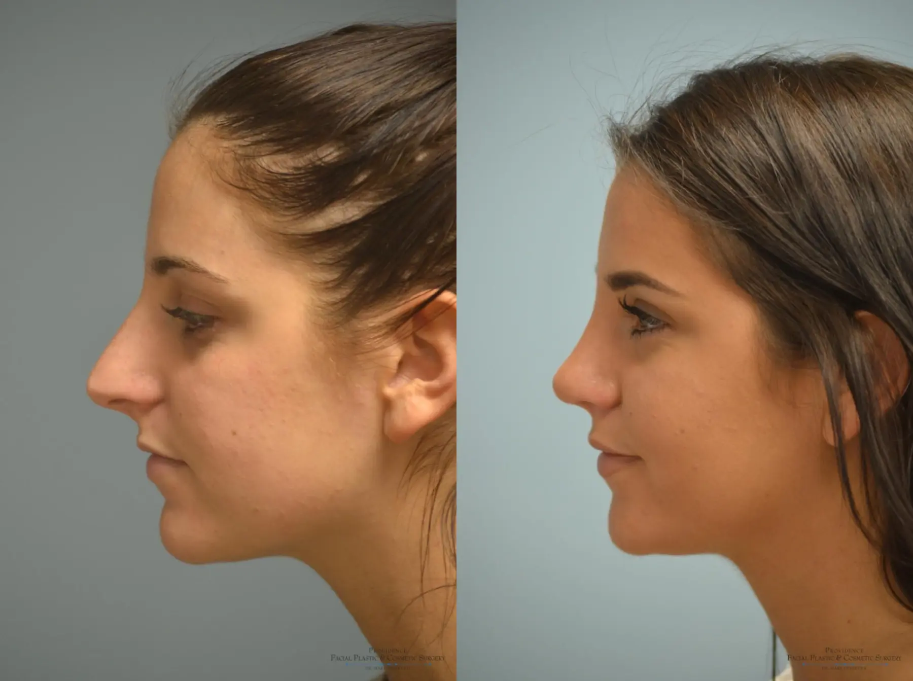 Rhinoplasty: Patient 17 - Before and After 3